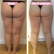 Smoothlift | Anti-cellulite treatment and leather tightening-4