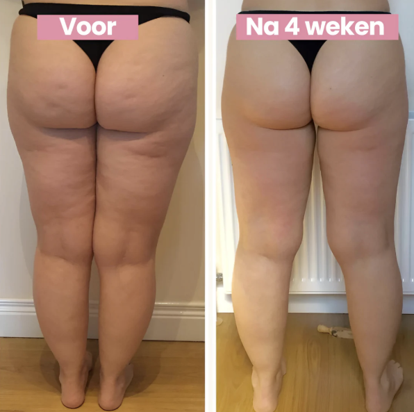 Smoothlift | Anti-cellulite treatment and leather tightening-4