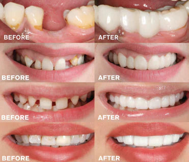 BrightBite - EasyClick Denture Prosthesis-5